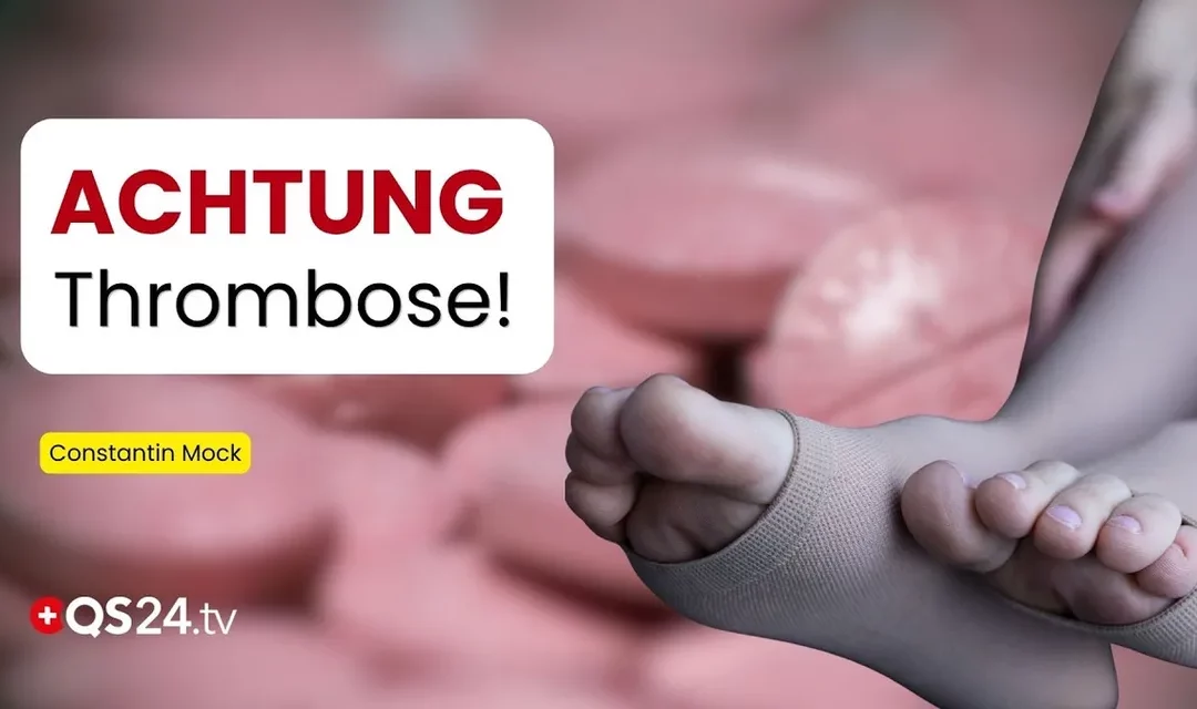 Krampfadern & Thrombose: Wann werden Krampfadern gefährlich?