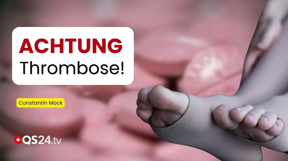 Beitrag: Krampfadern & Thrombose: Wann Krampfadern gefährlich